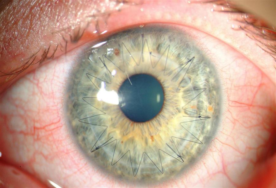 الدليل الكامل لزراعة قرنية العين - الجمال.نت