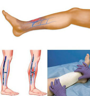 علاج سهل يتجاهله ملايين المصابين يساعد على قرح الساق المستعصية على الشفاء