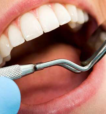  نظام جديد يوقف تسوس الأسنان قبل تفاقمه