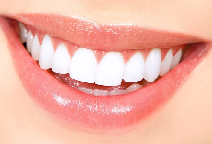 كيف تتراكم طبقة "البلاك" على الأسنان وطرق الحماية منها