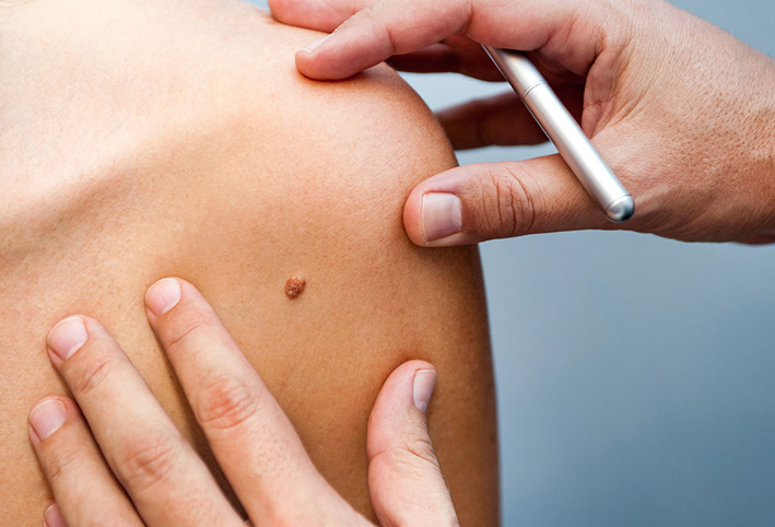 بعض عقاقير التهاب المفاصل قد تشكل أملا فى علاج سرطان الجلد