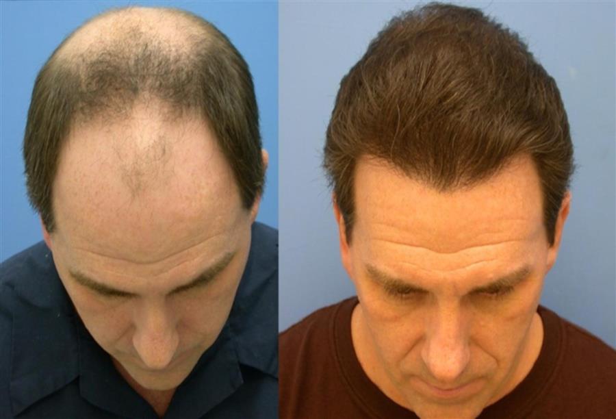 معلومات هامة عن زراعة الشعر الطبيعي