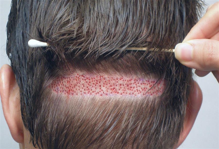 في لقاء خاص مع الجمال .. دكتور دانيال موران: يكشف أسرار زراعة الشعر الطبيعي