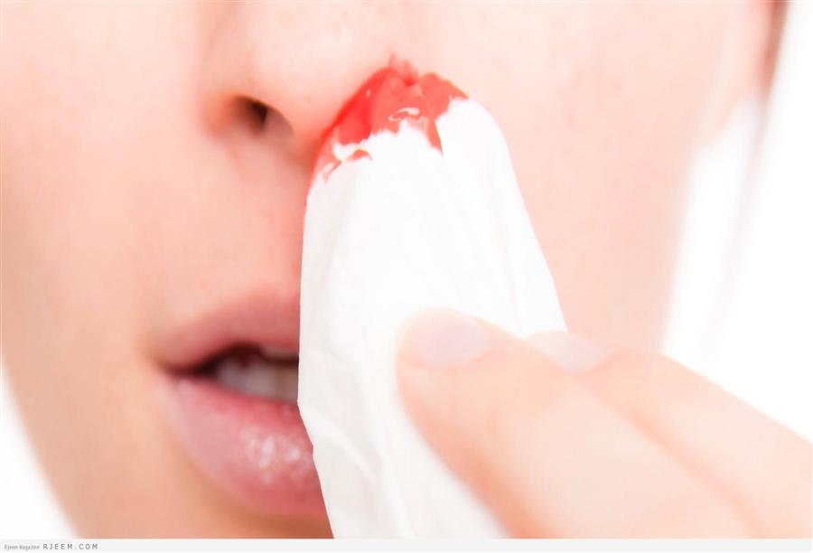 فكري في أسباب نزيف الأنف .. قبل البحث عن علاج