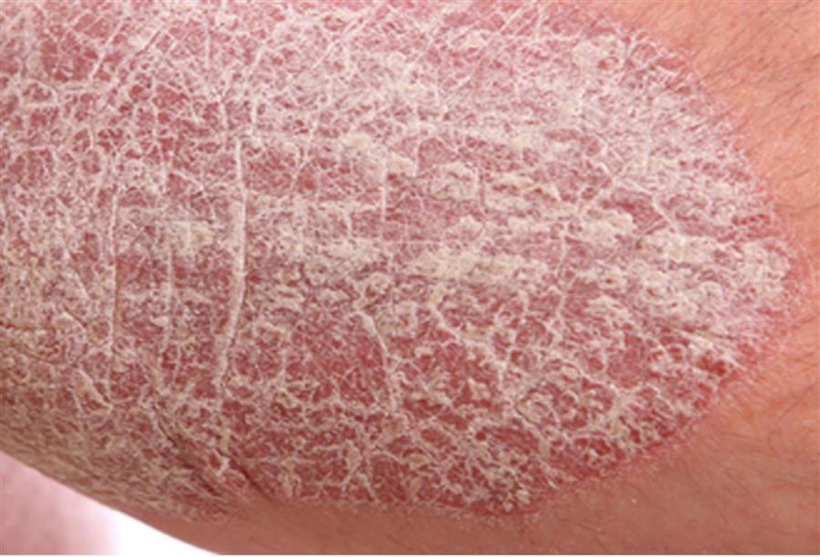 الدليل الكامل لأنواع وعلاج مرض الصدفية «Psoriasis»