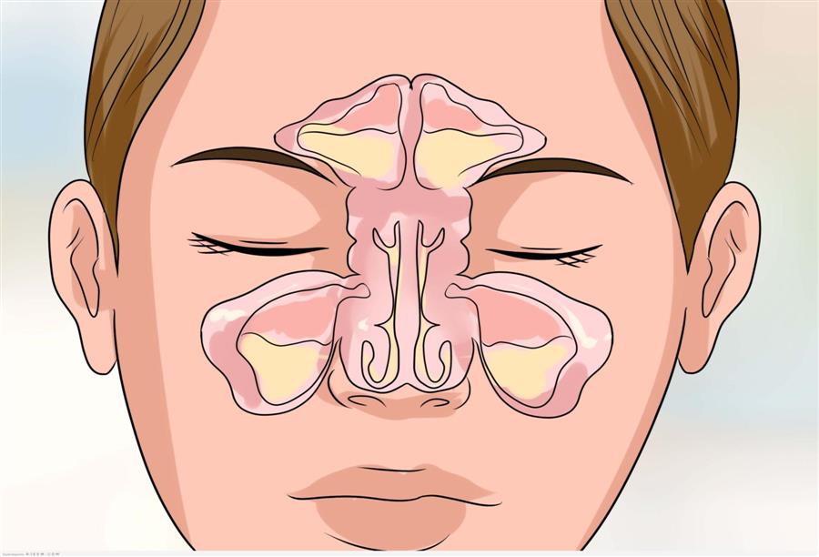 التهابات الأنف والجيوب الأنفية .. أسبابها وطرق علاجها