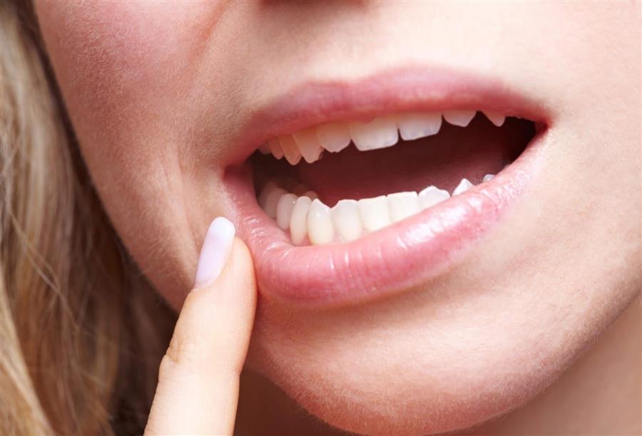 أسباب وطرق علاج تقرحات الفم المتكررة