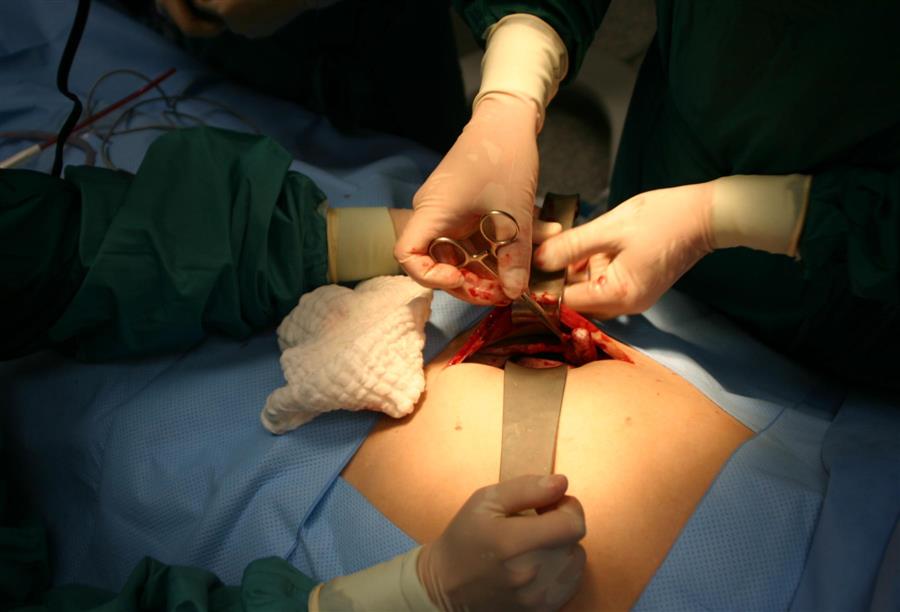 ازدياد عدد الجراحات القيصرية يثير قلق الأطباء