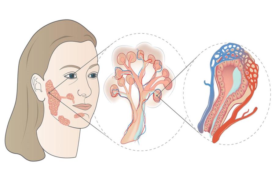 حصيات الغدد اللعابية .. وأحدث طرق علاجها