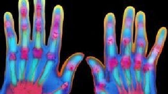 يامل العلماء في تطوير دواء لالم الالتهابات المزمنة