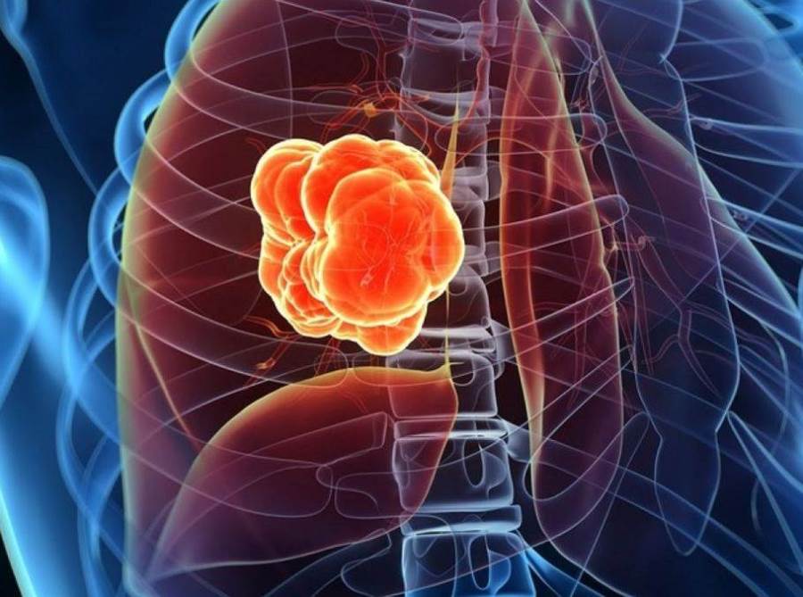 أسمنت وإبر وبالون للتخلص من سرطان المايلوما