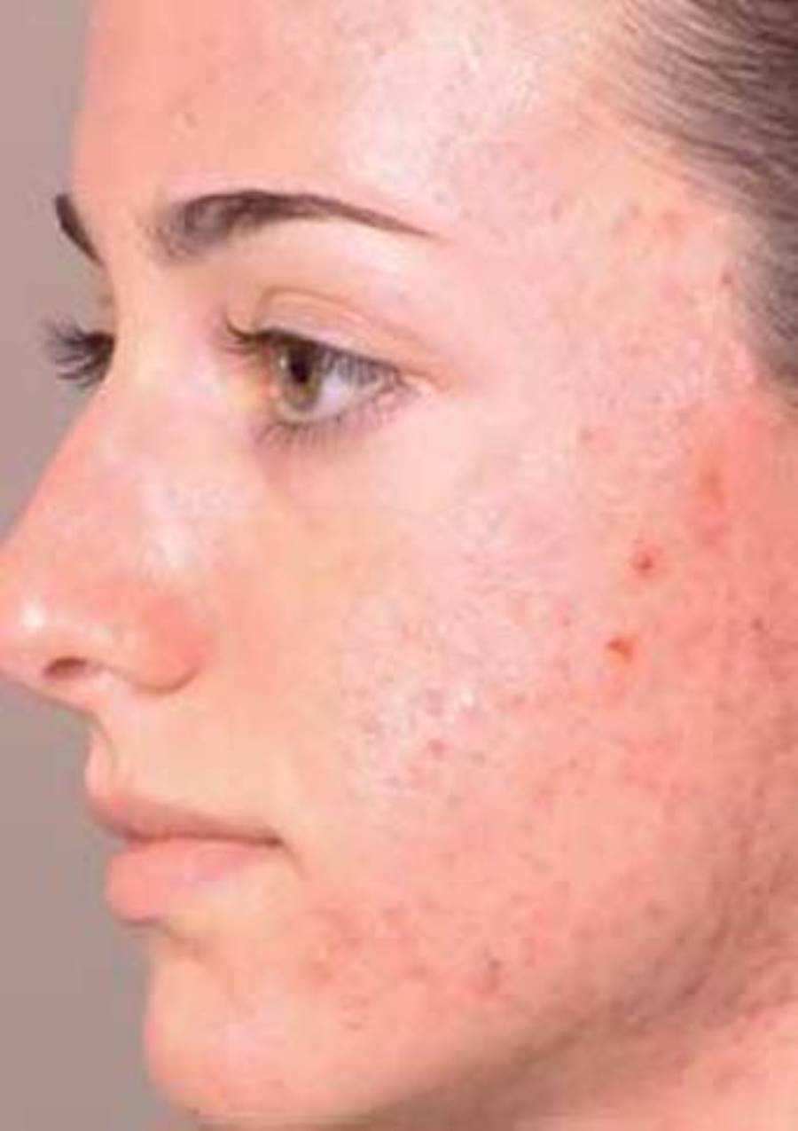 نصائح لتقليل حب الشباب