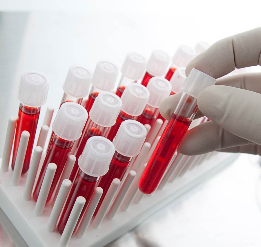 جديد/ تحليل دم يكشف عن أورام المخ المميتة