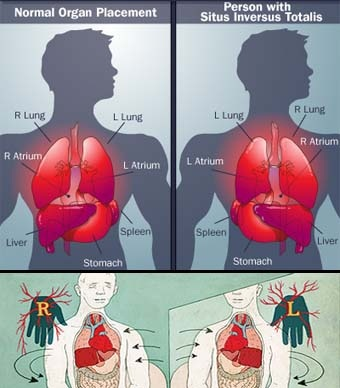 الوضع المقلوب للأعضاء حالة بين كل 20 ألفا