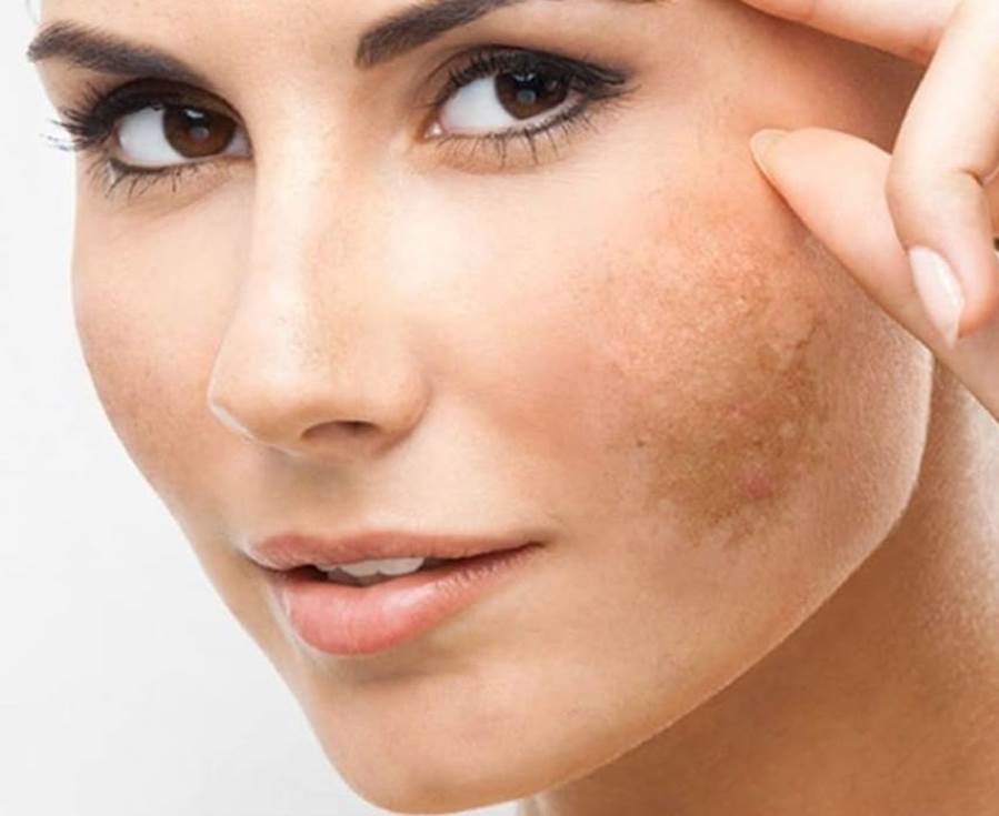 قناع لمعالجة كلف الوجه من خبيرة التجميل ليلي عبيد