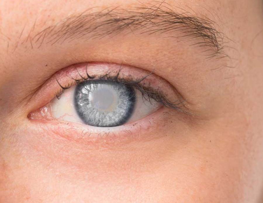  المواد المضادة للأكسدة .. كيف تقلل خطر الإصابة بإعتام عدسة العين؟