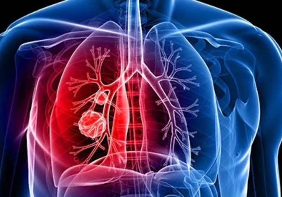 تراجع معدلات الإصابة بسرطان الرئة بين الرجال والسيدات في أمريكا
