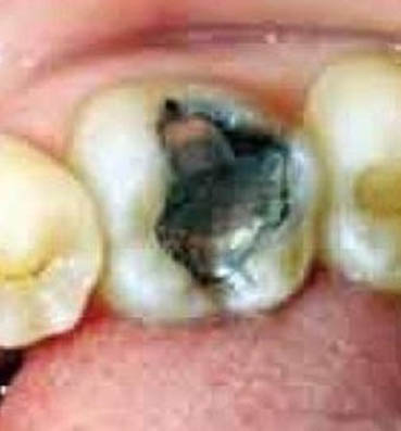 طرق طبيعية لعلاج تسوس الأسنان