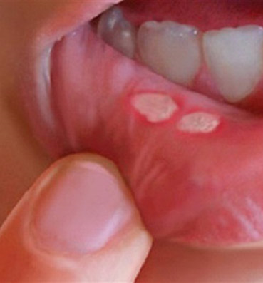 3 علاجات طبيعية للقضاء على تقرحات الفم 