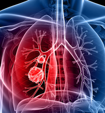 طفرة فى علاج سرطان الرئة تركز على تنشيط الجهاز المناعى