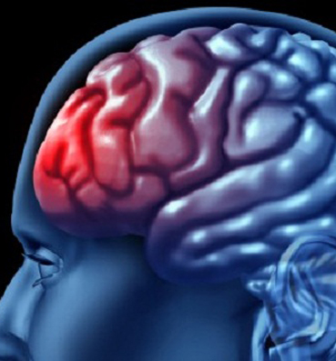 ابتكار عقار جديد لعلاج أضرار المخ الناتجة عن الإصابة بالسكتة الدماغية