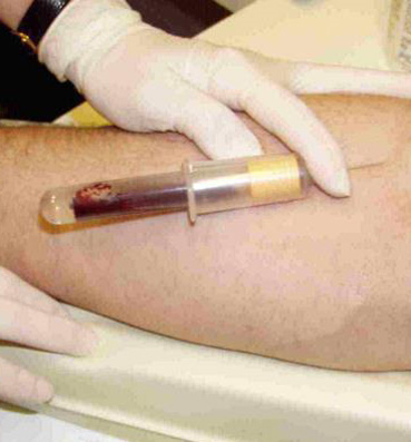 تطوير جهاز جديد لقياس قدرة الدم علي التجلط