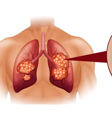 لماذا يصاب غير المدخنين بسرطان الرئة وما هي أخطر أعراضه؟