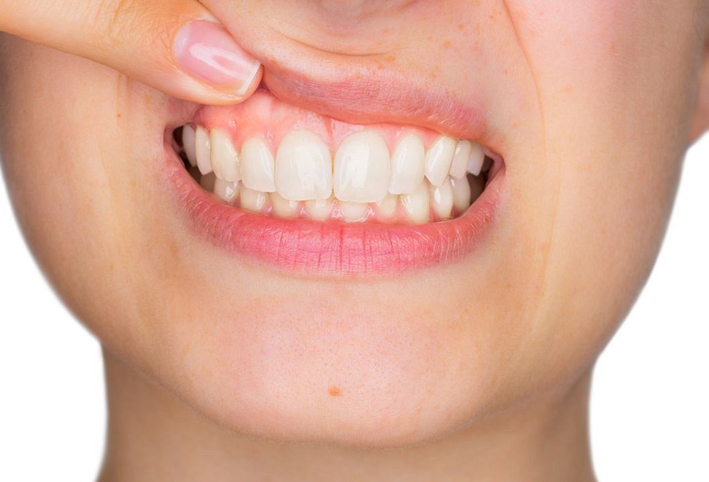 مؤشرات صامتة لأمراض اللثة .. تعرفي عليها