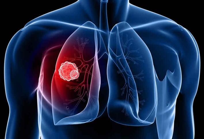 أسباب سرطان الرئة ابرزها التدخين والتلوث