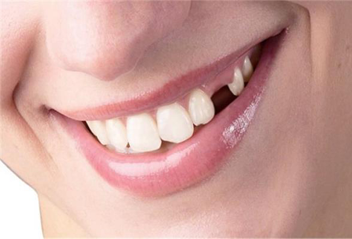 سقوط الأسنان مؤشر مهم لسوء التغذية