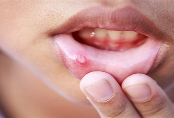 بكتيريا الفم قد تصيبك بالزهايمر