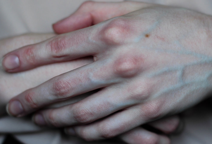 لماذا يحدث انتفاخ الأوردة في اليدين والذراعين؟