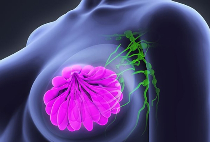 زيادة حجم الثدى يعرض النساء للسرطان بنسبة 10%