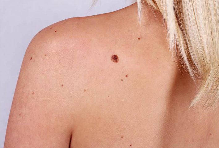 "الشامات الحمراء" على بشرتك قد تكون نوعا من سرطان الجلد