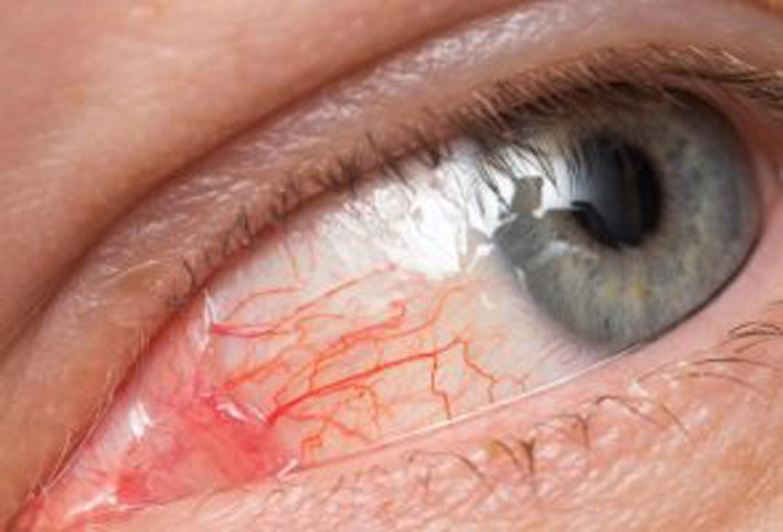 ماذا تعلم عن مرض العين الوردية وما هى أسباب الإصابة به؟