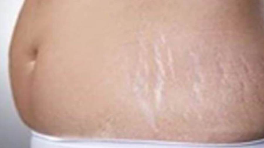 زالة علامات التمدد الموجودة على الجلد