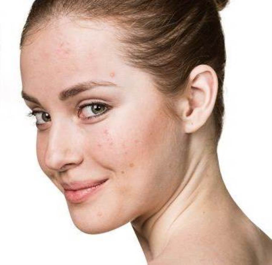 للبنات .. 3 أسباب غير متوقعة تؤدي إلى ظهور حب الشباب