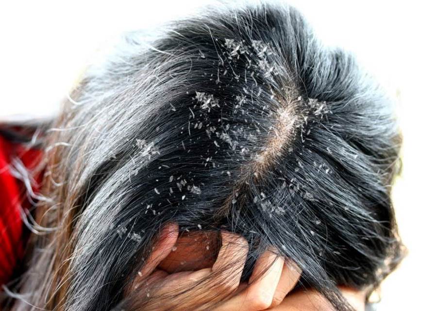 هل يمكن أن تسبب قشرة الرأس تساقط الشعر؟