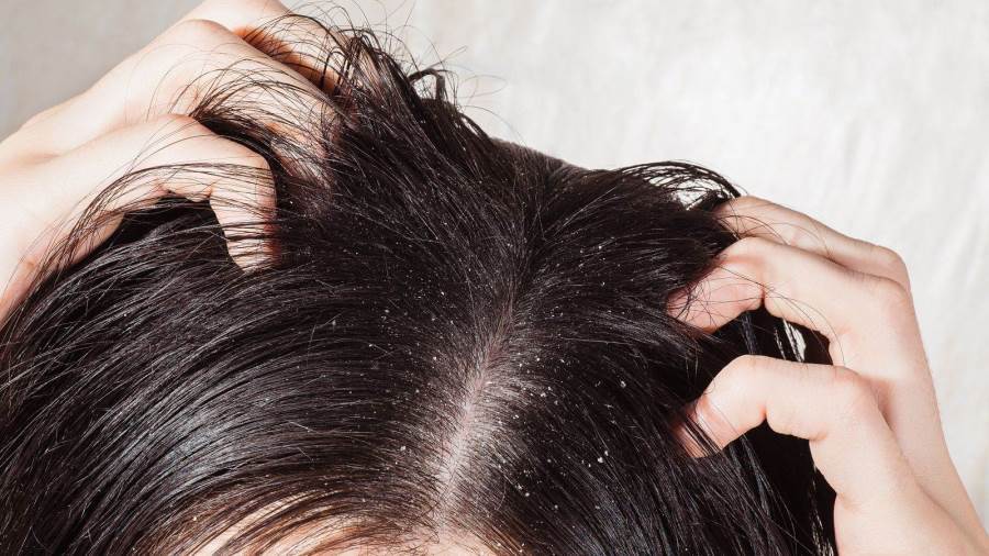 طرق طبيعية للتخلص من قشرة الشعر