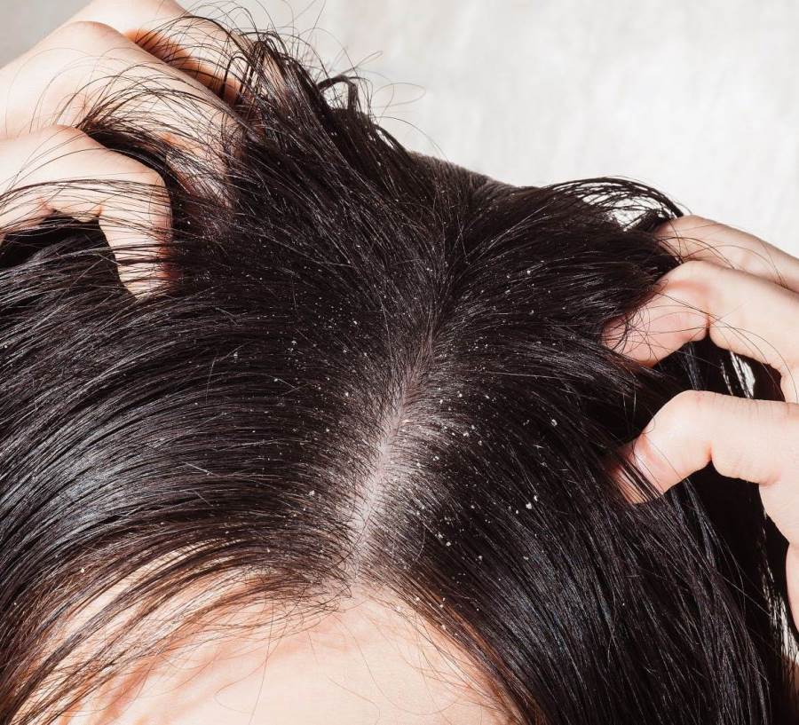 طرق طبيعية للتخلص من قشرة الشعر