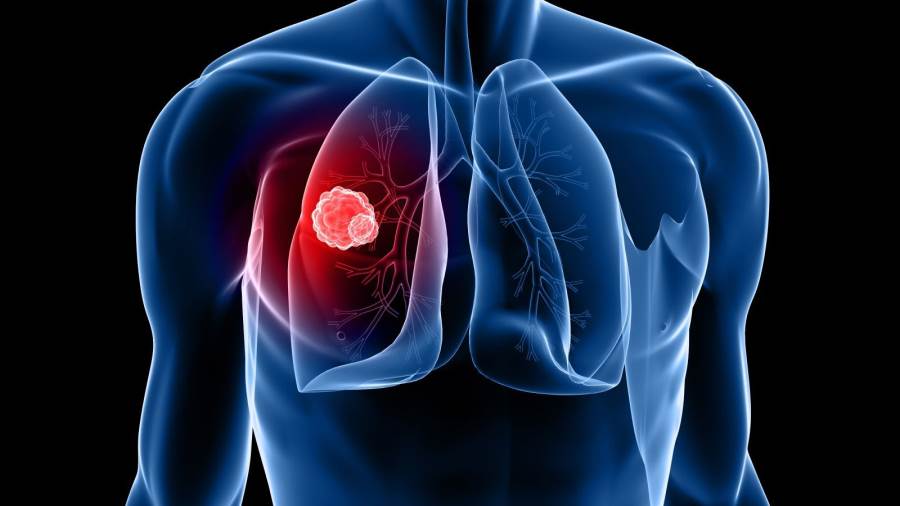 سرطان الرئة