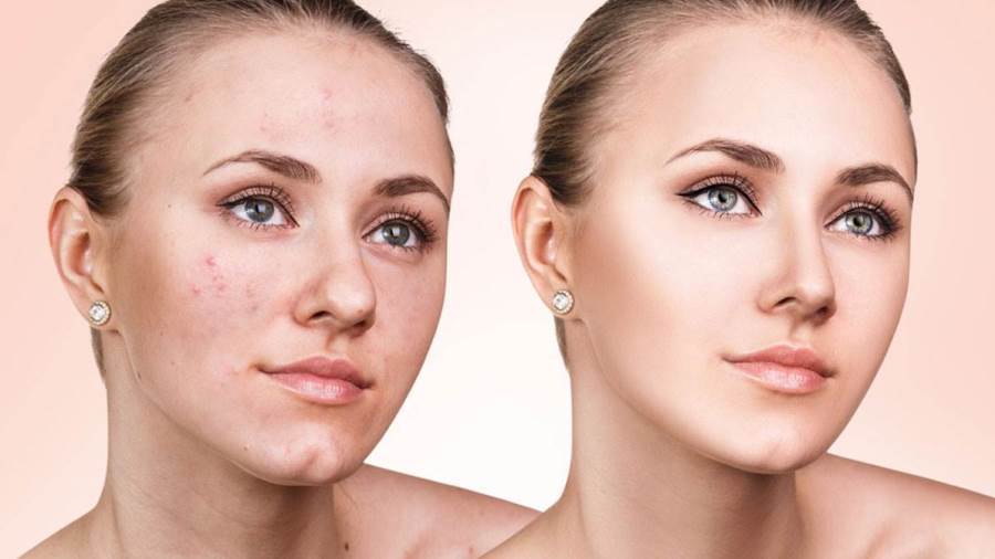 علاجات طبيعية لعلاج حب الشباب