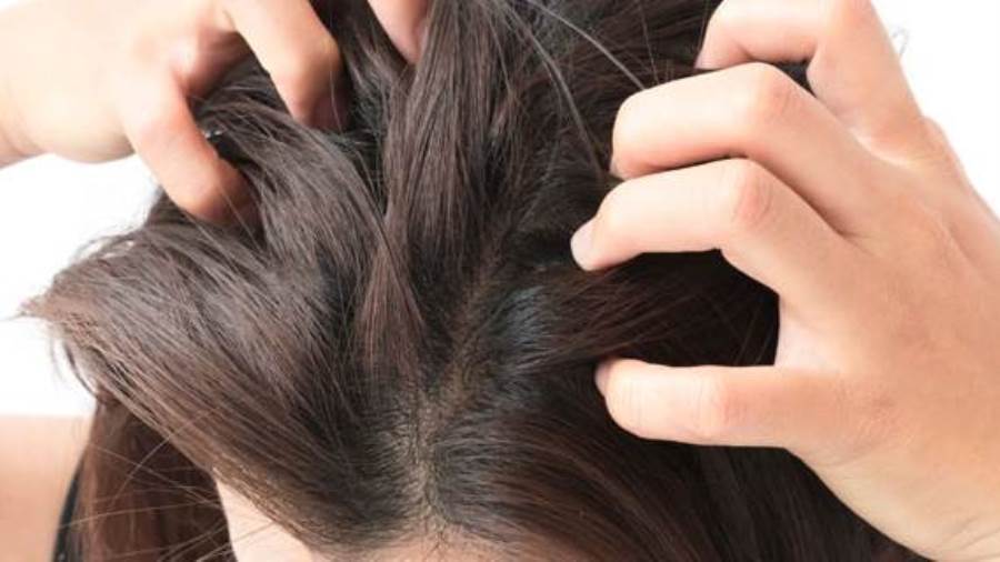 علاج حكة الرأس