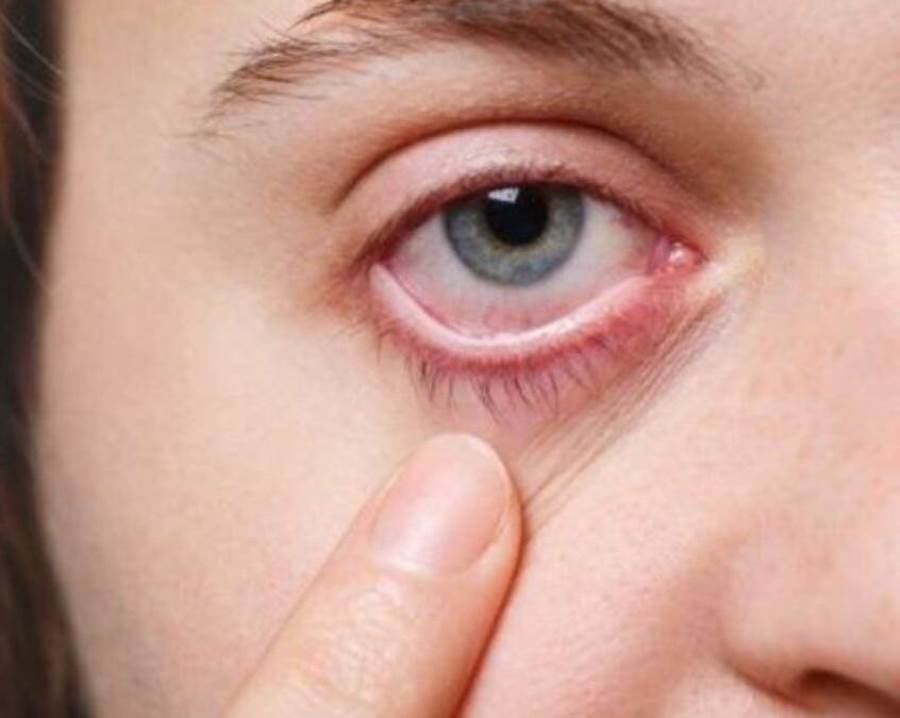 أسباب وأعراض العين الوردية وهل هى معدية؟