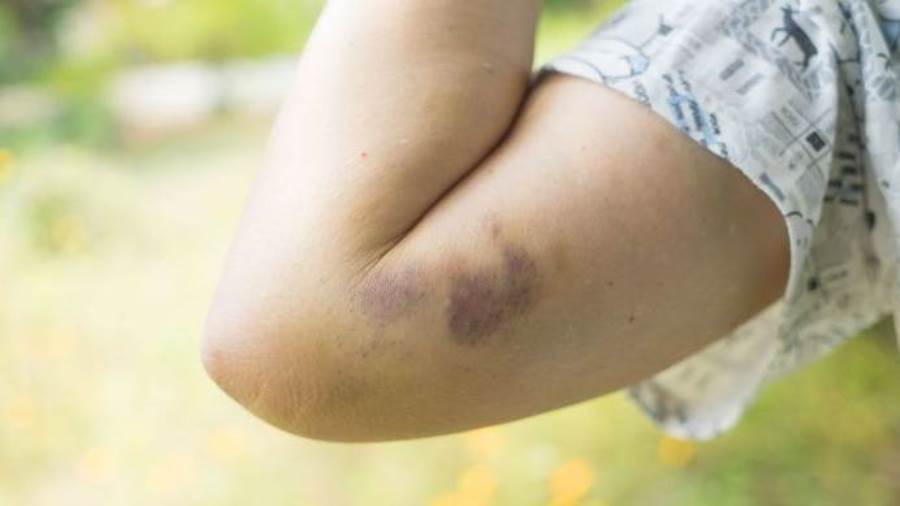 لماذا تظهر بقع زرقاء على جسدك