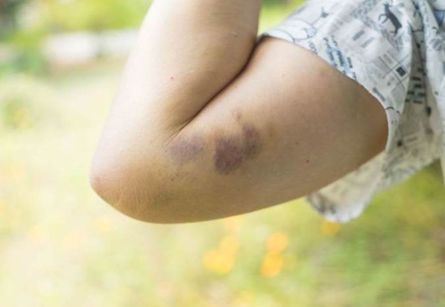 لماذا تظهر بقع زرقاء على جسدك؟