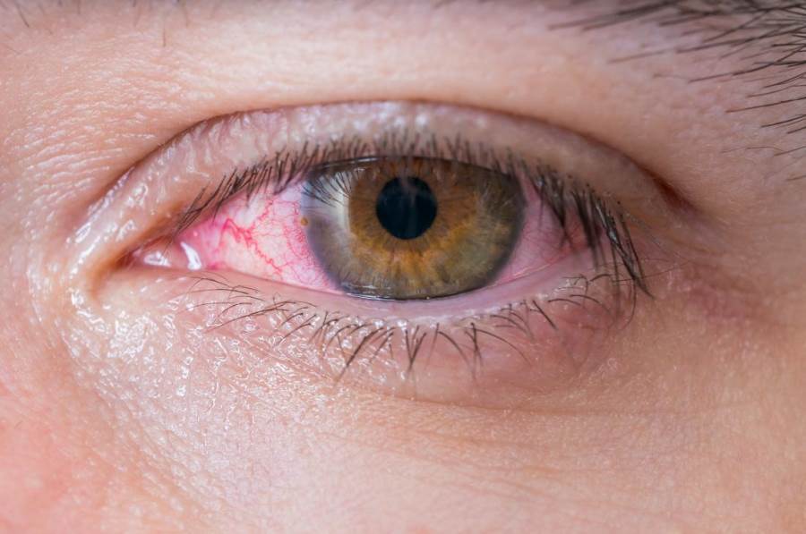 ظهور علامات في العين.. من أعراض أوميكرون الجديدة