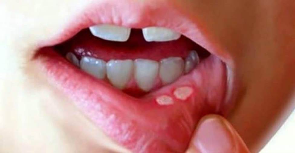 فطريات الفم عند الأطفال.. أسبابها وطرق الوقاية
