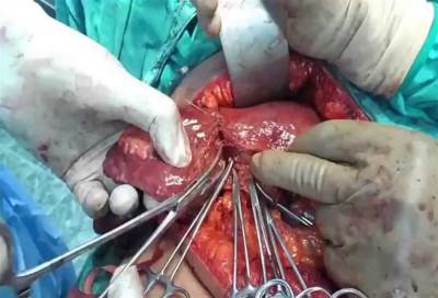 زراعة الكبد .. تقدم العمر ليس حائلا دون إجرائها