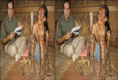 إندونيسي يتحول إلى "شجرة" نتيجة إصابته بمرض نادر